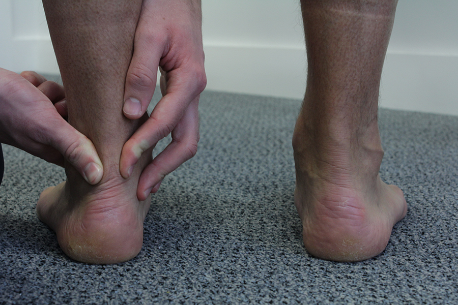 Achilles tendonitis | Above ankle 