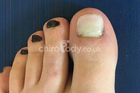Toenail reconstruction | Cosmetic podiatry | Treatments  |  Leading chiropodist & Podiatrists in Manchester and Liverpool