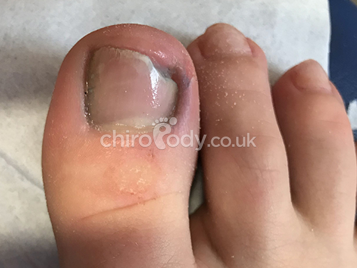 How to Treat a Black Toenail: Causes & Treatments