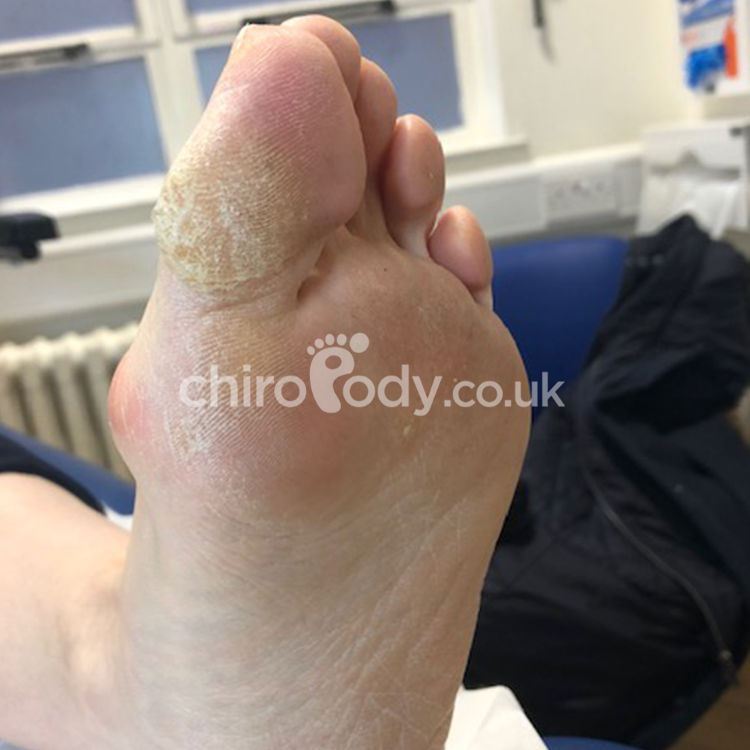 A foot before treatment.