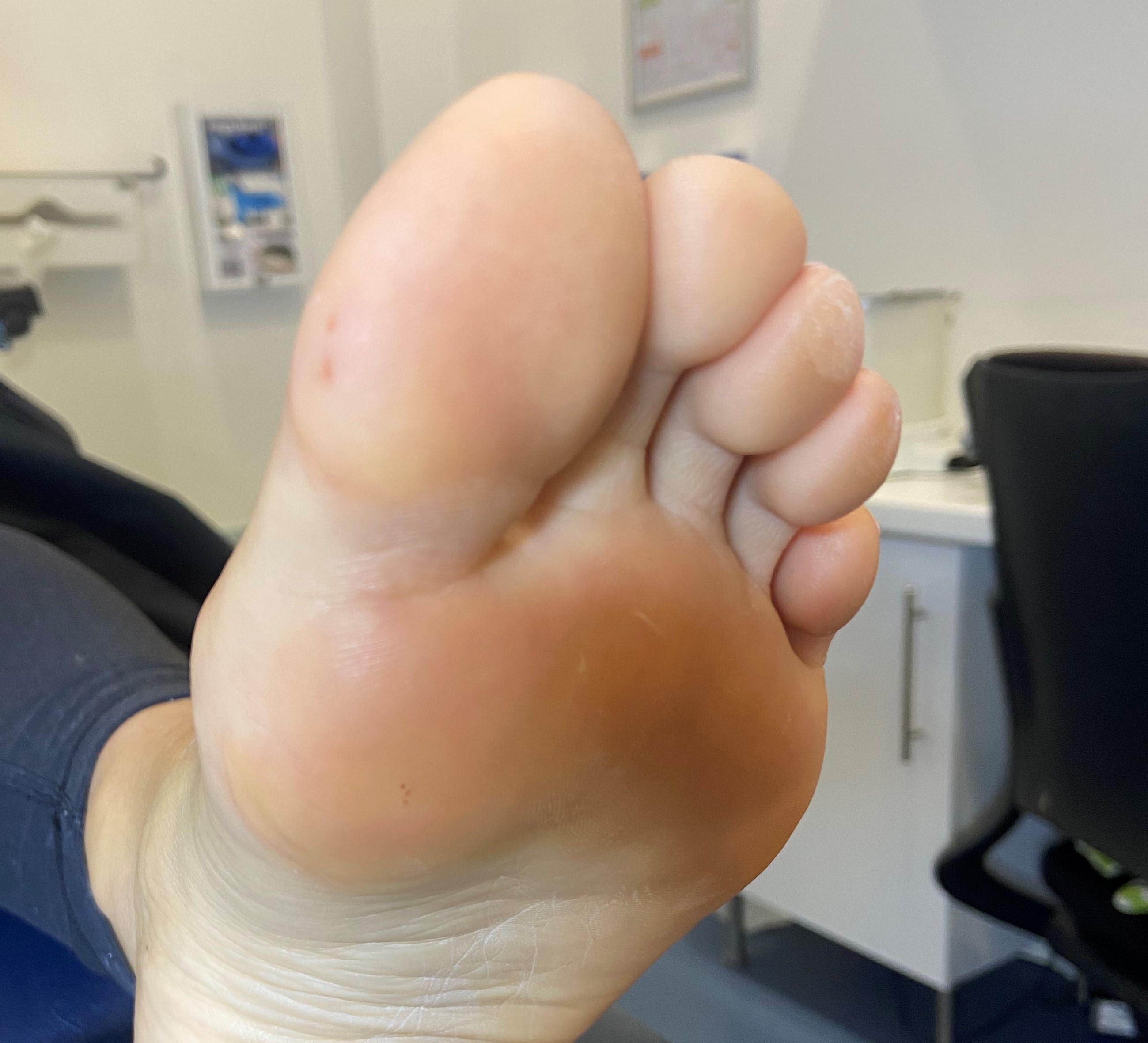 A foot before treatment.