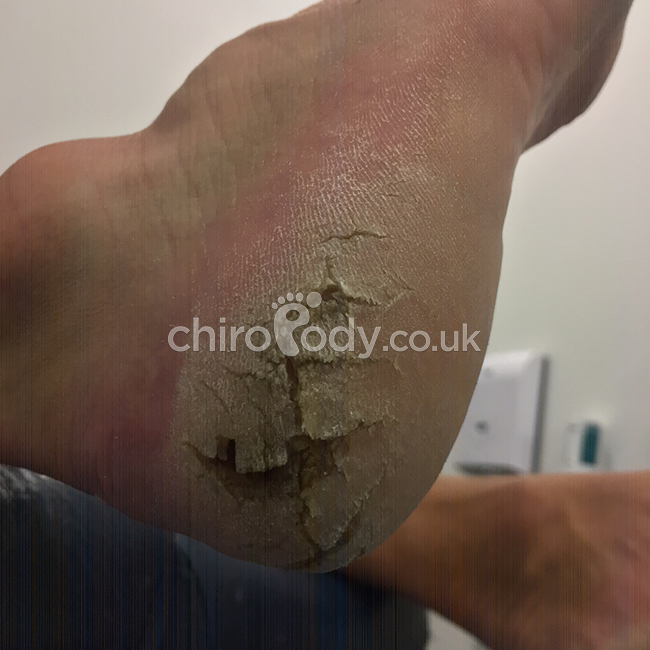 Cracked heels | What we treat | Manchester Podiatry | Leading podiatry  provider in Manchester.