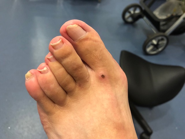 A foot before treatment.