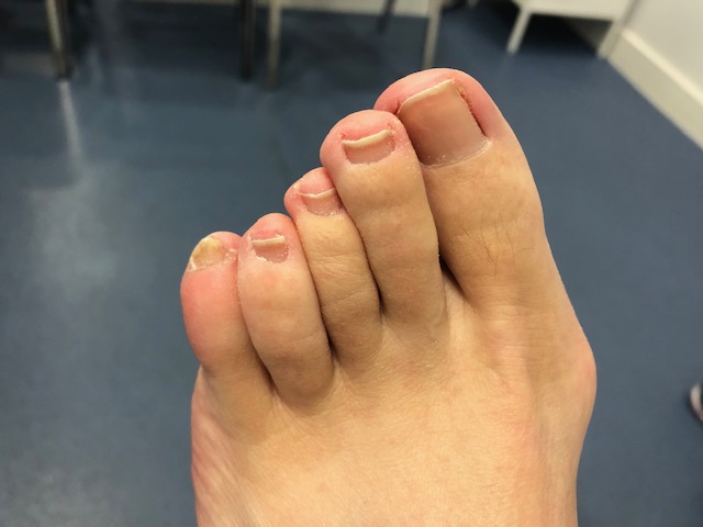 A foot before treatment.